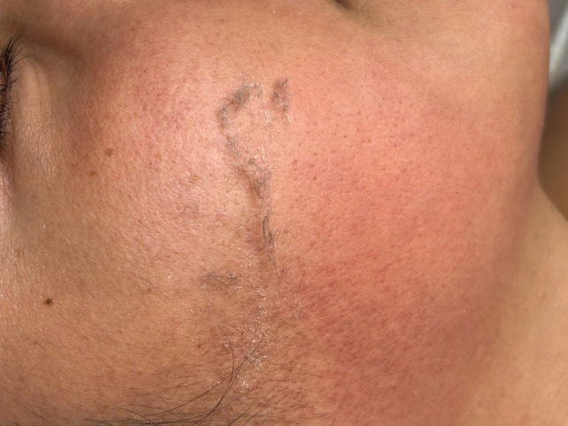 Piel muerta eliminada durante el dermaplaning