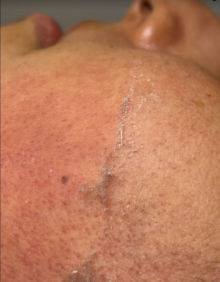 durante el dermaplaning